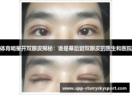 体育明星开双眼皮揭秘：谁是幕后割双眼皮的医生和医院